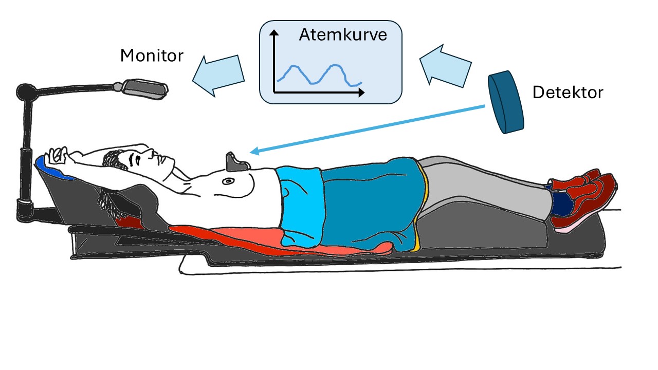 Skizze der atemgetriggerten Strahlentherapie