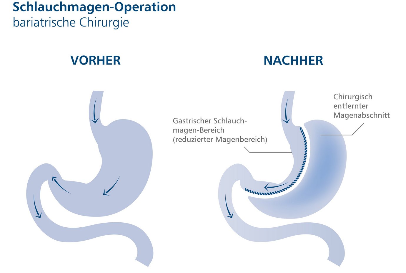 Illu Schlauchmagen
